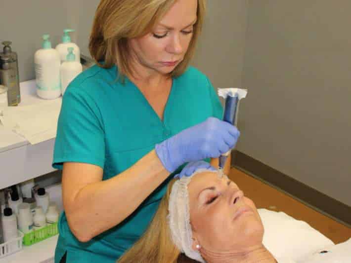 Microneedling treatment at Skinspirations